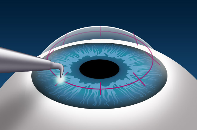 Best Cornea Specialist in Jaipur