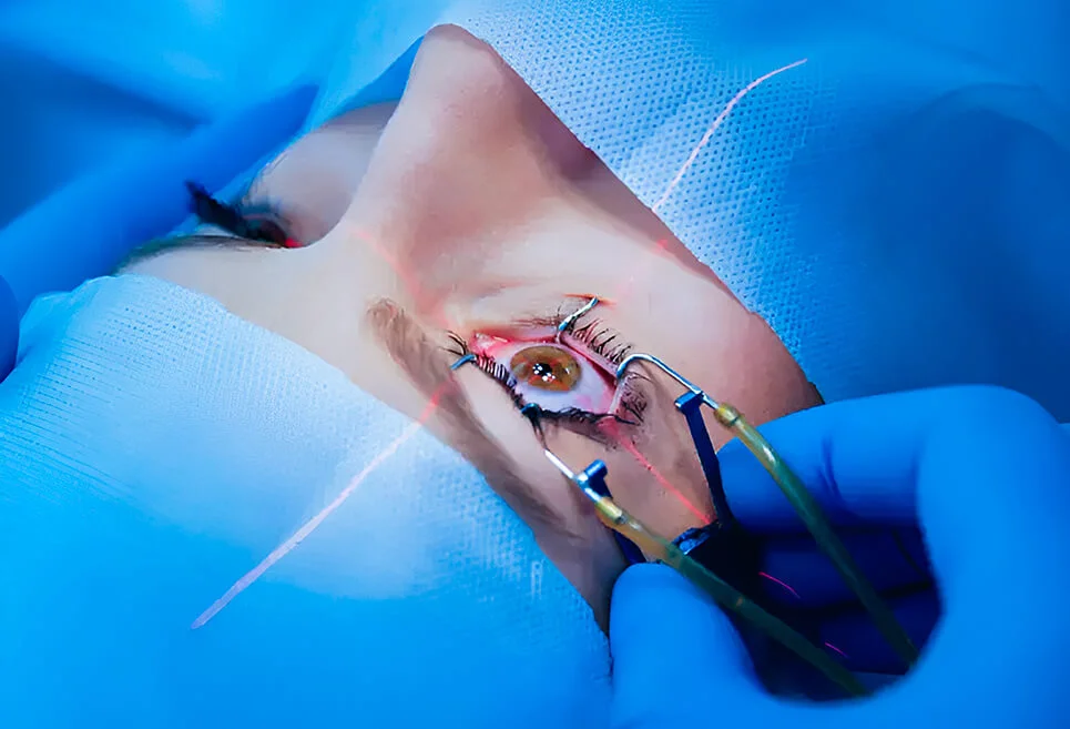 LASIK Surgery