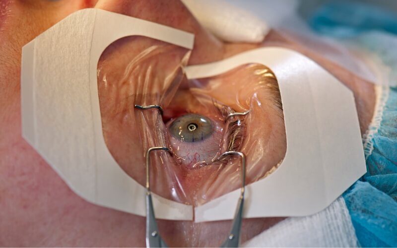 Retinal Detachment Surgery Jaipur